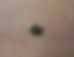 seborrhoeic keratoses.jpg