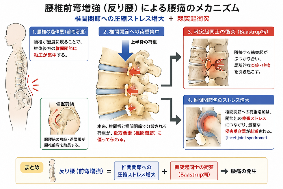 反り腰による腰痛発生のメカニズム