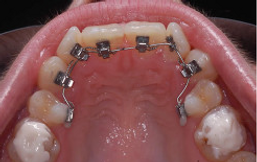 Lingual Orthodontics Dentist Cheltenham