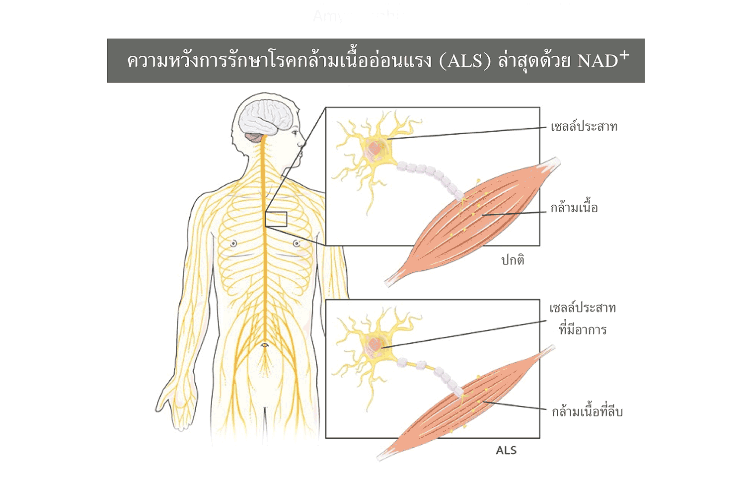 ความหวังการรักษาโรคกล้ามเนื้ออ่อนแรง (ALS) ล่าสุดด้วย NAD+