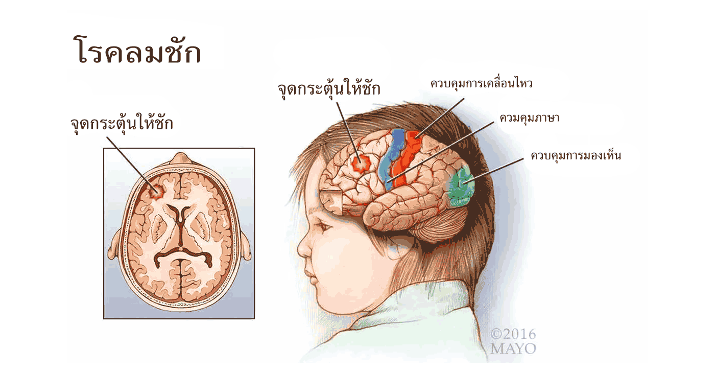 โรคลมชัก - NAD+ แนวทางใหม่ที่ใช้ในการรักษา