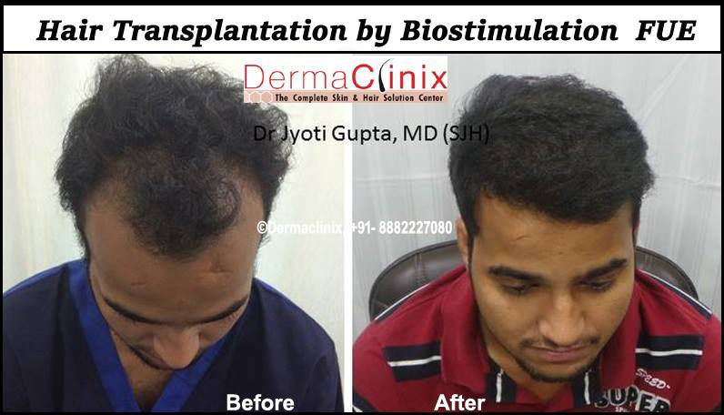hair restoration center in delhi