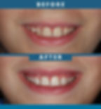 Before After Image of a patient that underwent routine composite bonding procedure at Sandvick DDS & Associates by Dr. Nicole Sawatzke, a budding star in the cosmetic dental field.