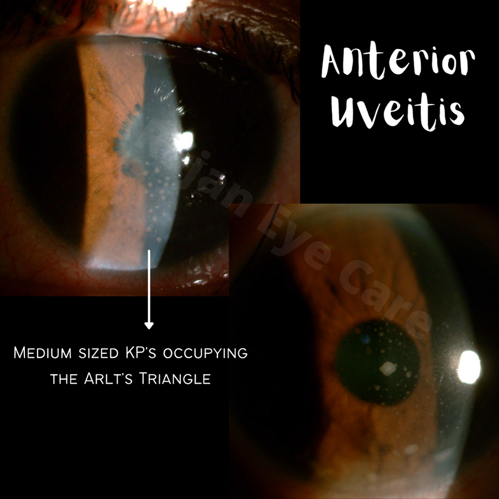 Granulomatous VS NonGranulomatous Uveitis.