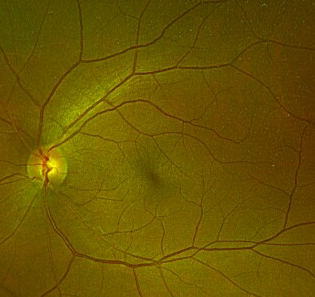 Why Dilated Retinal Examinations Matter