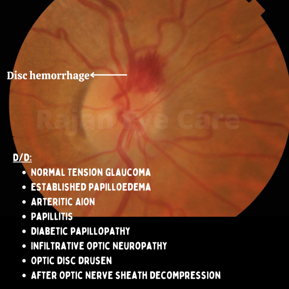 Disc Hemorrhages Differential Diagnosis!