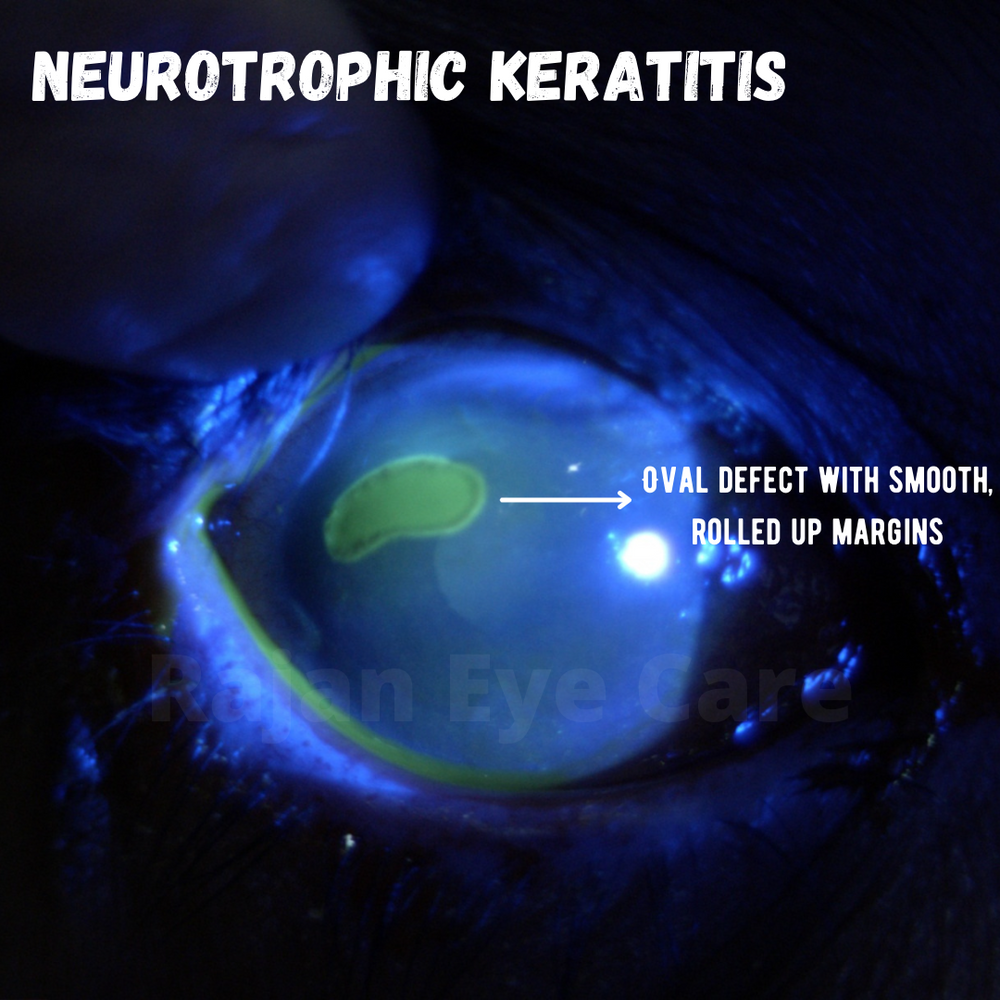 Mackie Classification of Neurotrophic Keratitis.
