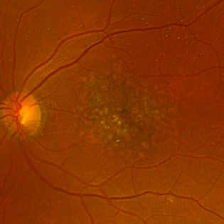 Protect Your Sight: Essential Facts About Age-Related Macular Degeneration (AMD) 