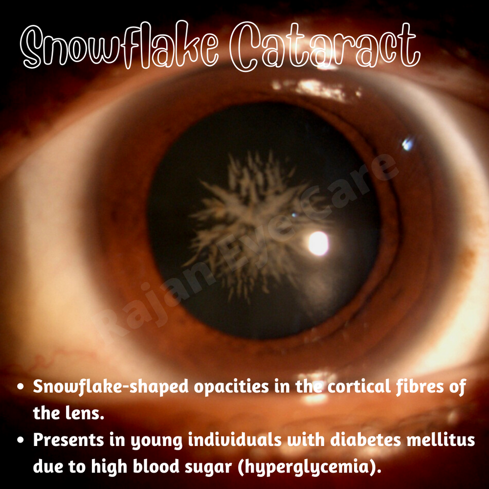 Snowflake Cataract!