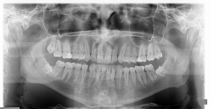 mental foramen.jpg