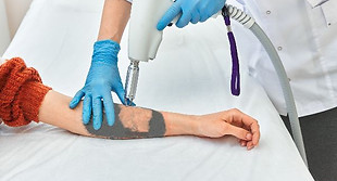 Tatoeages remover