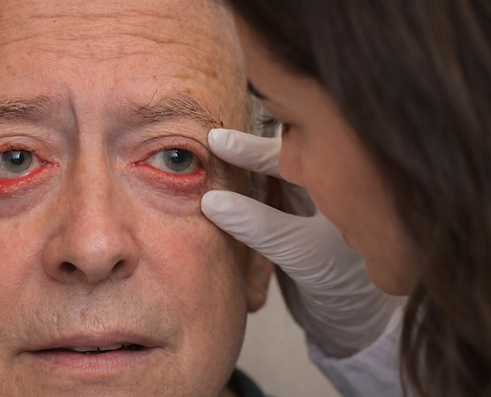 Ectropion y Entropion