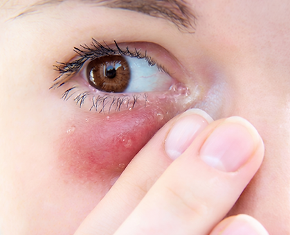 DACRIOCISTORRINOSTOMÍA EXTERNA