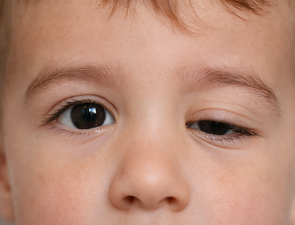 Parpado caido en bebé