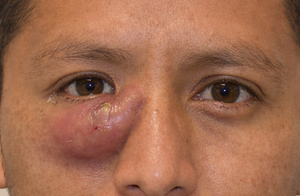 Infección en el lagrimal