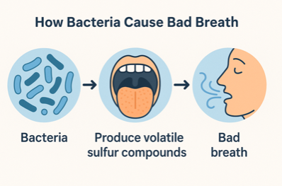 Diagram of how bacteria causes bad breath. Comprised of 3 main components: Bacteria produces Volatile Sulfur compounds which results in bad breath.