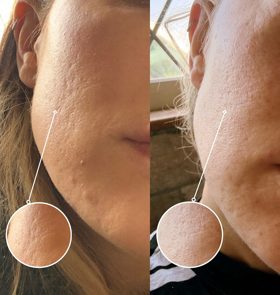 Before and after comparison of acne scar revision results, showing improved skin texture and reduction in visible atrophic scarring following personalised treatment.