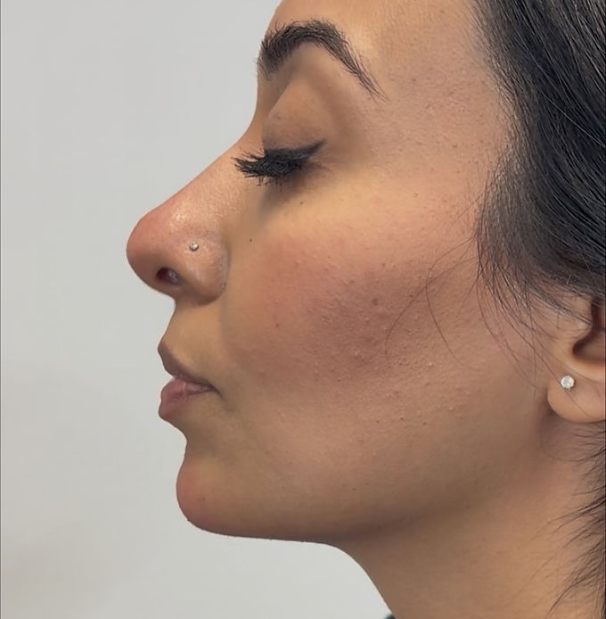 Liquid rhinoplasty results