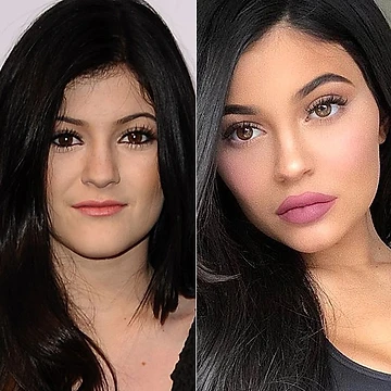 Before/after facial injections Kylie Jenner