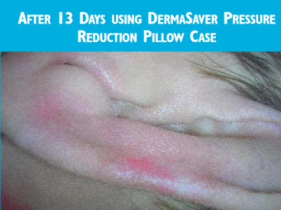 Thumbnail: Pressure Reduction Pillowcase – PC1300