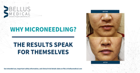 SkinPen -Why Microneedling.png