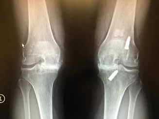 Double Knee Replacement Journal- Day 1