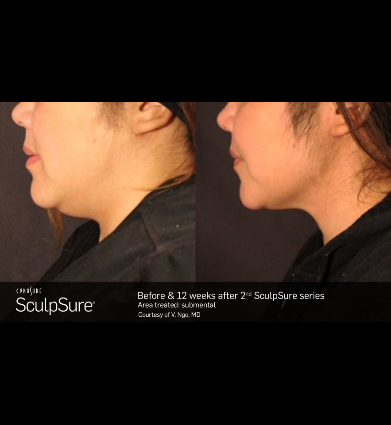 SculpSure Submental laser fat reduction