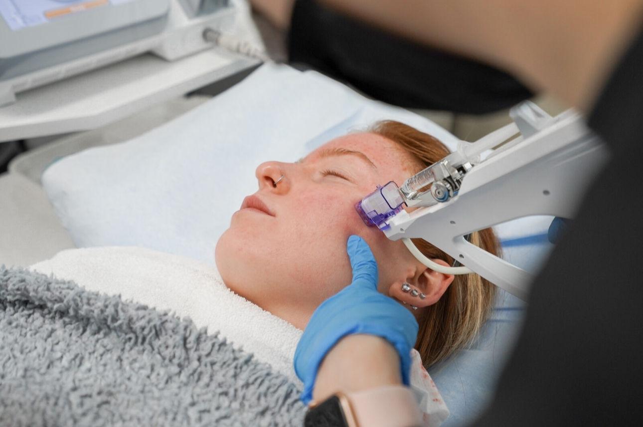 PRP+HA microneedling