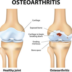 If your weight is suffering, then your joints might be too! 