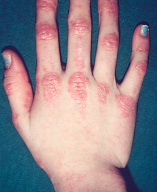 Gottron, dermatomiosite