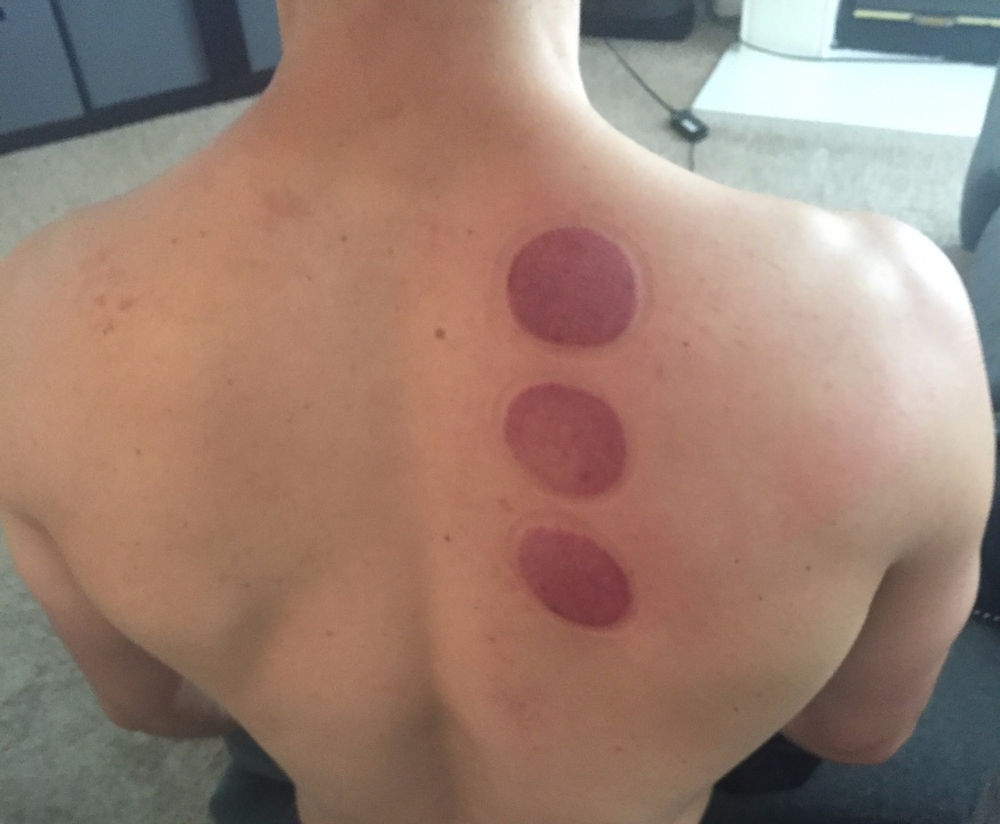 Cupping What is it? What does it do?