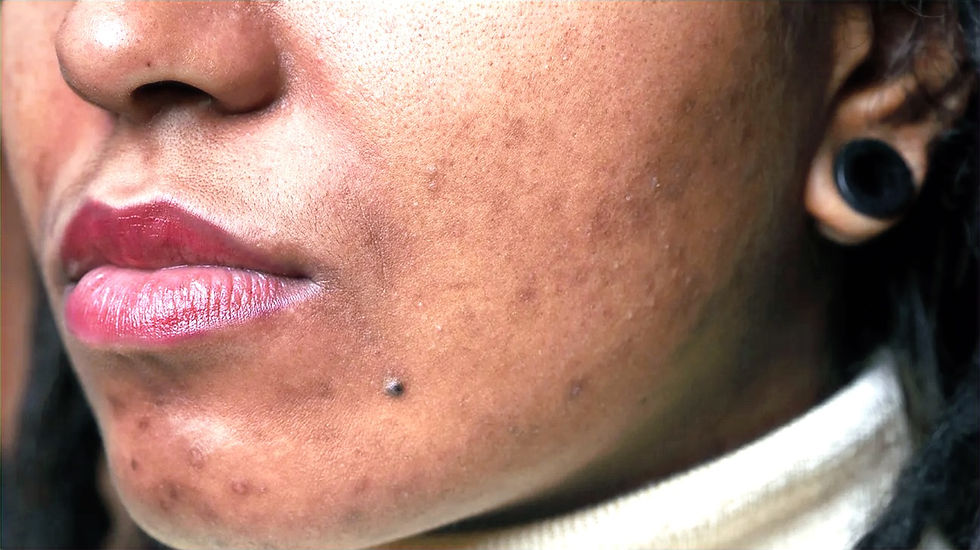 Damaged Skin