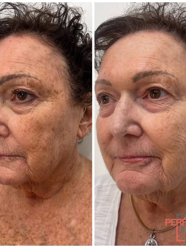 BBL después de un tratamiento. Trata el daño solar, la hiperpigmentación, las rojeces y las venas. BBL en Tampa, en Perfectly Bare Laser