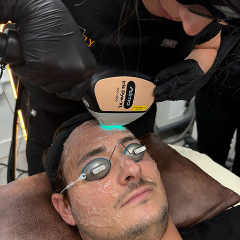 Alma DyeVL in Tampa at Perfectly Bare Laser  Tampa MedSpa