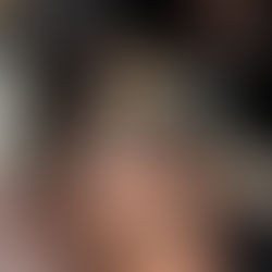 Best Rosacea Treatments options Near Me: How Professional Care Can Calm Redness and Restore Your Skin