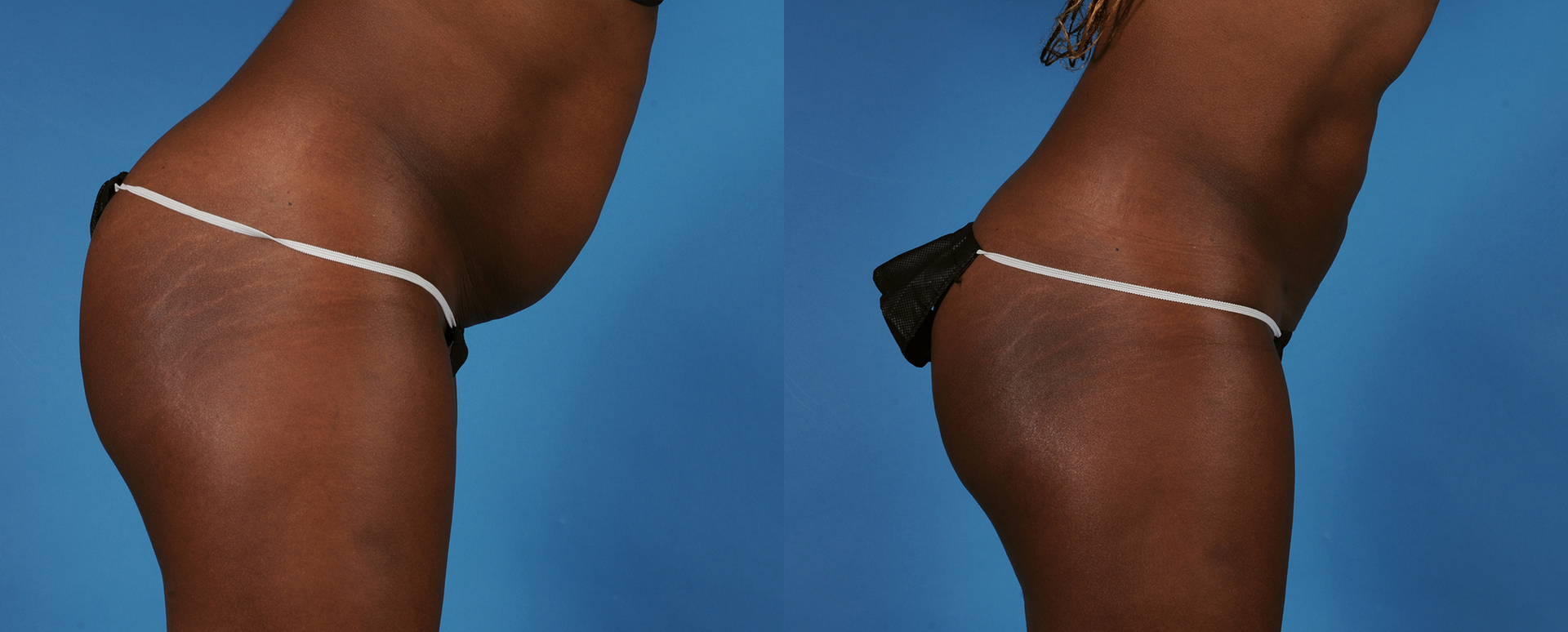 Before and after of a woman who had a BodyTite procedure done at Horizon Med Spa and Wellness in Kansas City.