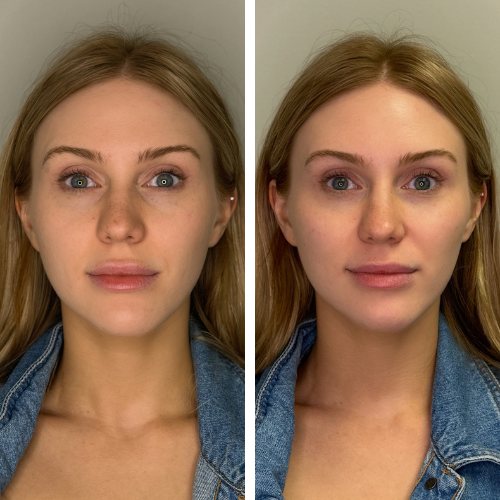 Before and after cheek and undereye filler