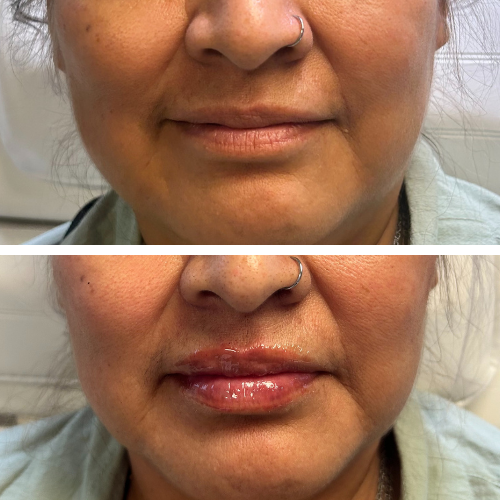 Before and after lip filler