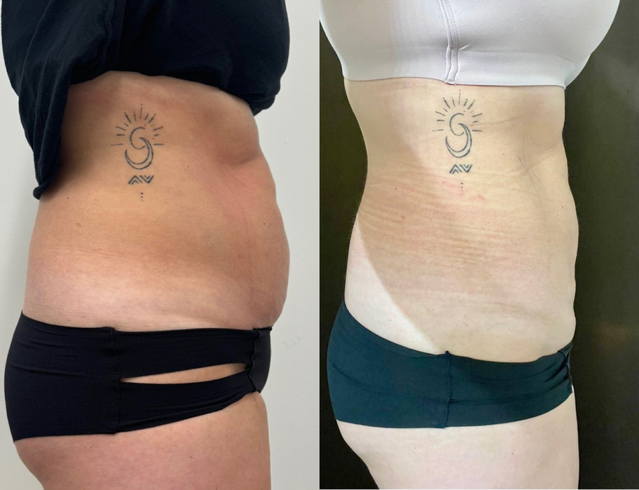 Before and after of a woman who had a BodyTite procedure done at Horizon Med Spa and Wellness in Kansas City.