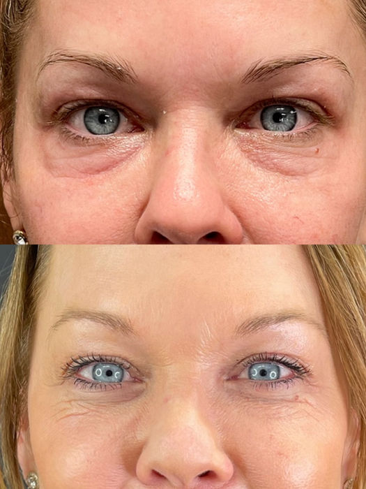 A before and after comparison of a woman with a Morpheus8 Microneedling Treatment by Horizon Med Spa.