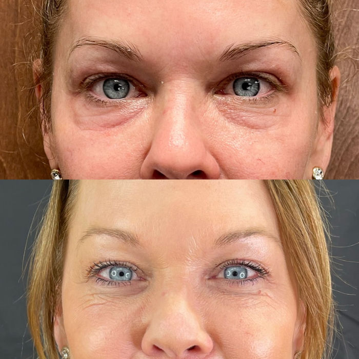 A before and after comparison of a woman with a Morpheus8 Microneedling Treatment by Horizon Med Spa.