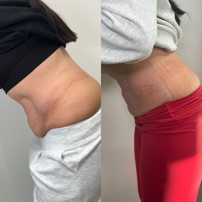 Before and after of a woman who had a BodyTite procedure done at Horizon Med Spa and Wellness in Kansas City.