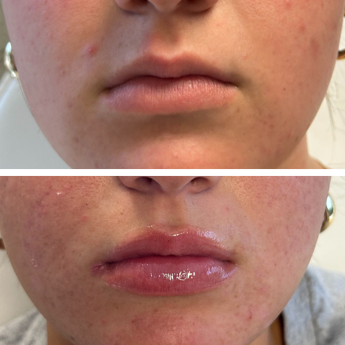 Before and after lip filler