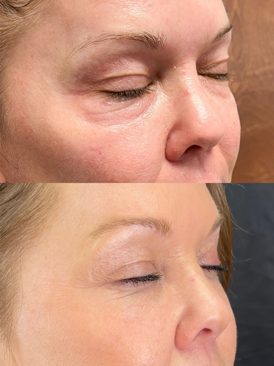 A before and after comparison of a woman with a Morpheus8 Microneedling Treatment by Horizon Med Spa.