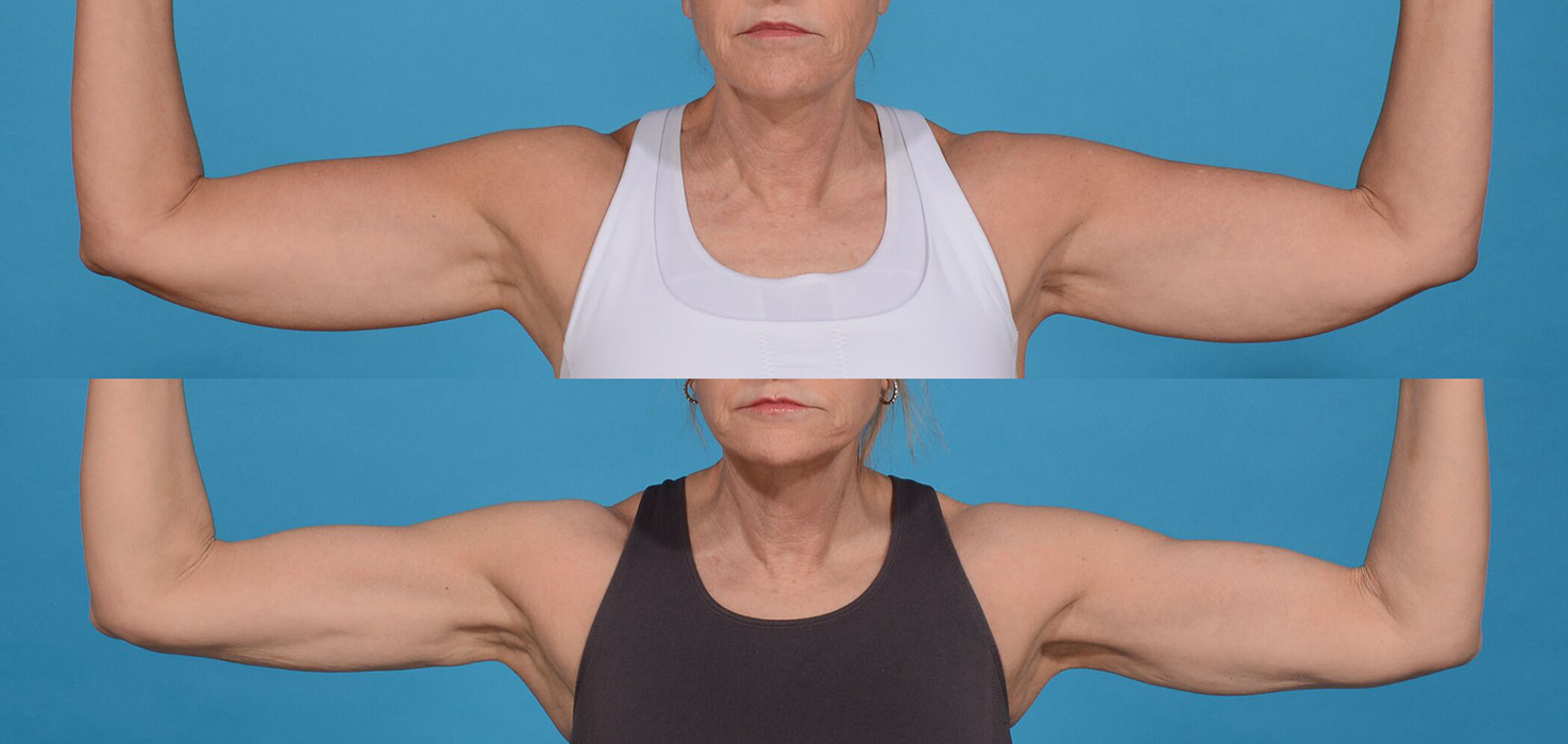 Before and after of a woman who had a BodyTite procedure done at Horizon Med Spa and Wellness in Kansas City.