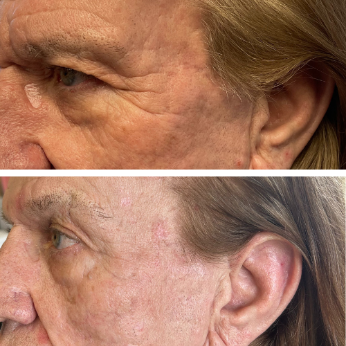 Before and after Morpheus8