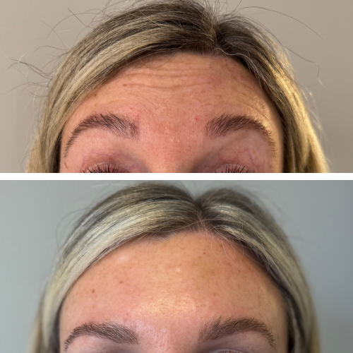 Before and after forehead botox