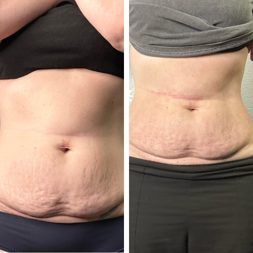 Before and after Morpheus8