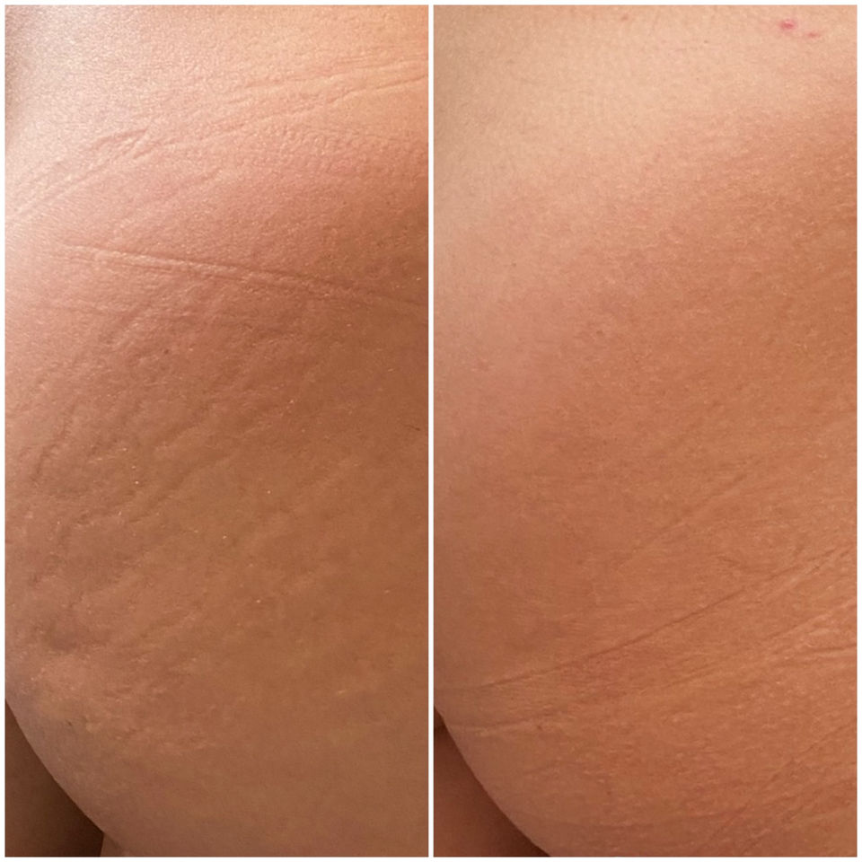 A before and after comparison of a woman with a Morpheus8 Microneedling Treatment by Horizon Med Spa.