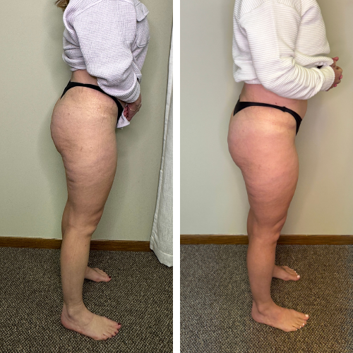 Before and after Venus Legacy RF